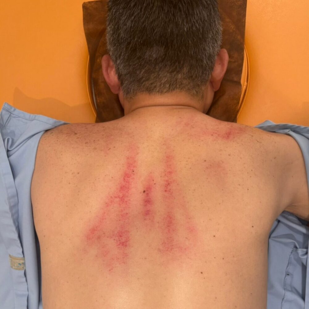 筋膜リリースで内出血した画像の安全性